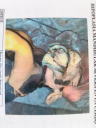 Espécimen de Anomalía Glosomandibular Congénita Con Hipoplasia Mandibular