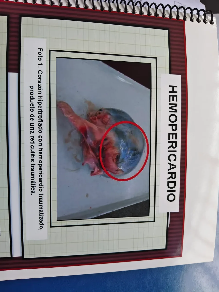 Espécimen de Hemopericardio