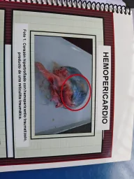 Espécimen de Hemopericardio