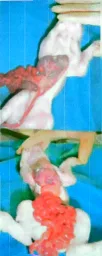 Espécimen de Schistosoma Reflexus Incompleto En Cerdo